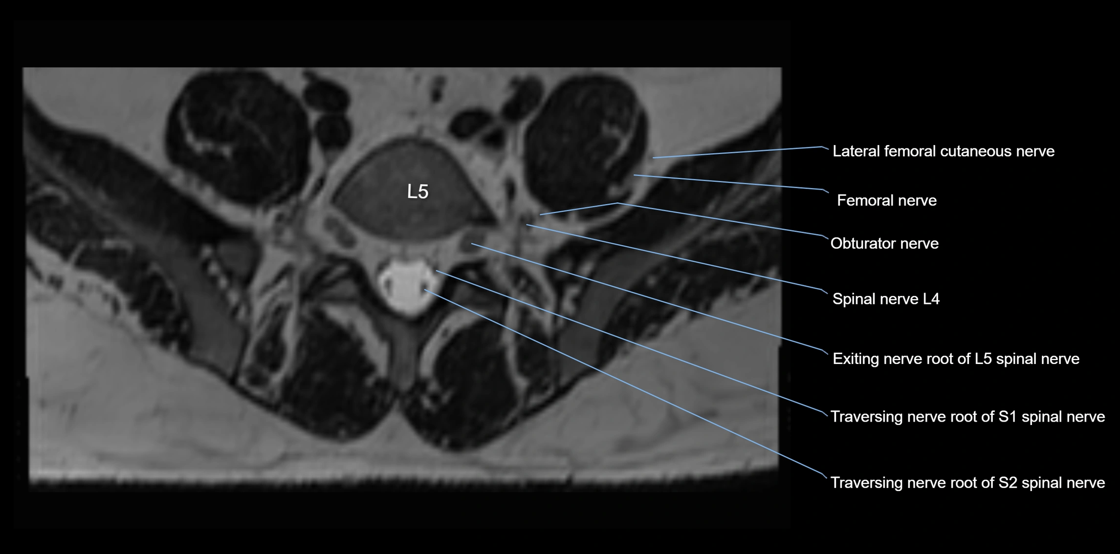 MR lumbosacral plexus axial cross sectional anatomy 3T  radiology  image-img-1008001-00059.webp